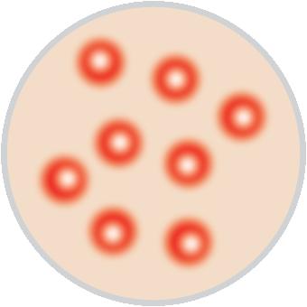 hormonal-cystic-acne