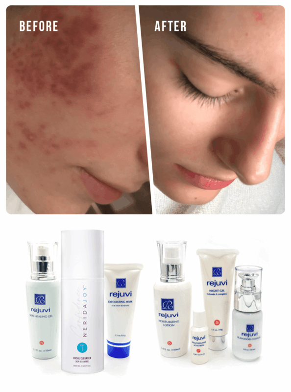 Hormonal Acne