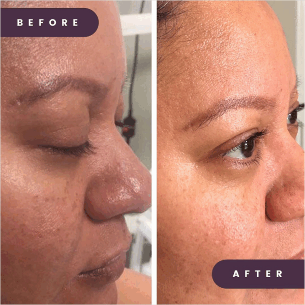 2beforeafter