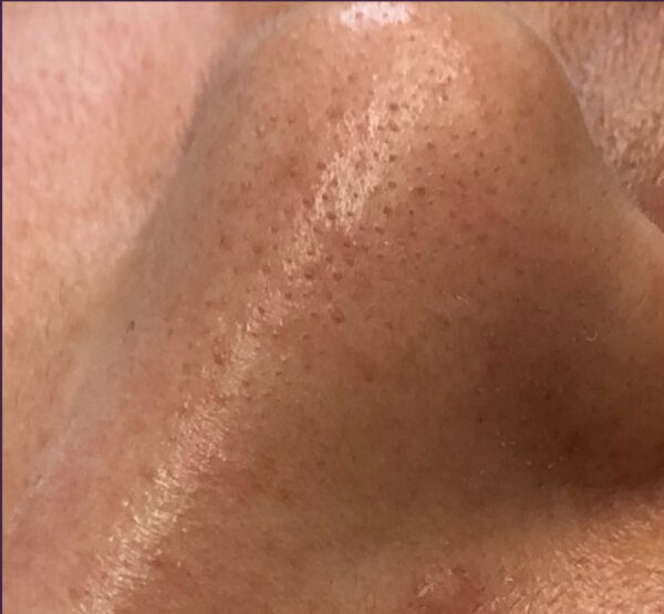 blackhead1